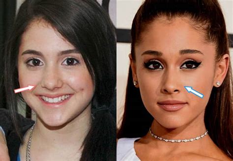 Did Ariana Grande Have Plastic Surgery? (Before & After 2021)