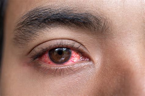 Red Eyes Problem | Red Eye Treatment in Kuala Lumpur (Malaysia)