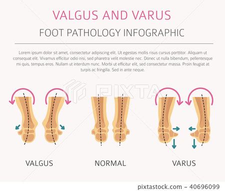 Foot varus and valgus medical infographic. - Stock Illustration ...