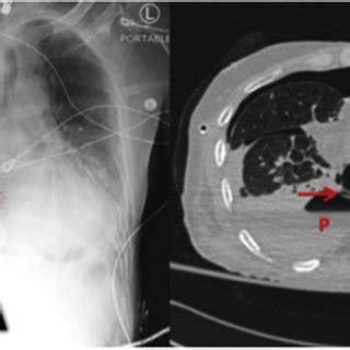 Presenting symptoms of tension hydropneumothorax in Boerhaave syndrome ...