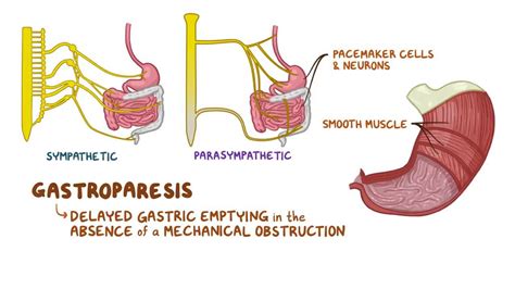 Gastroparesis: Clinical: Video, Anatomy & Definition | Osmosis