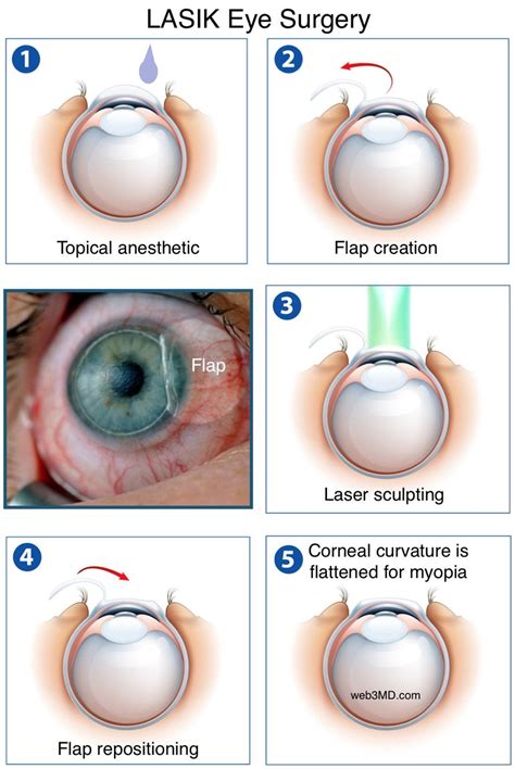 My LASIK Eye Surgery Experience. This article is not written by a… | by ...