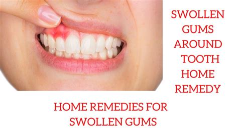 Best Of The Best Info About How To Get Rid Of Swollen Gums - Householdother