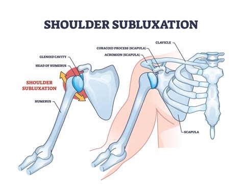 Shoulder Subluxation - Causes & Best Treatment Options in 2024