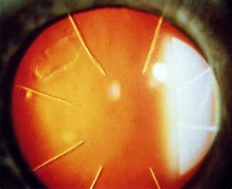 Radial keratotomy surgery - American Academy of Ophthalmology