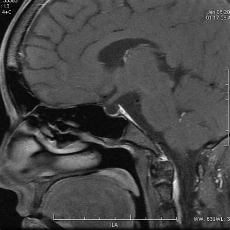 Sagittal t1 weighted MRI-brain image shows sella turcica is replaced by ...