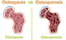 Osteopenia vs. Osteoporosis | New Health Advisor