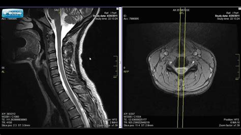 Normal Cervical Spine MRI Explained | Dr. Jeffrey P.Johnson | HD - YouTube