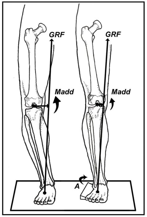 Varus and Valgus Insole Posting: An Inexpensive and Effective ...