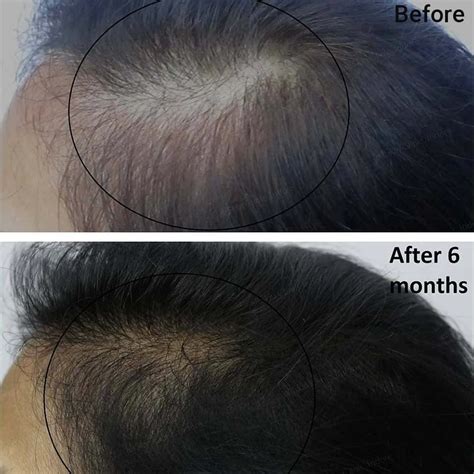 Derma Roller Hair Regrowth - Everything You Need to Know