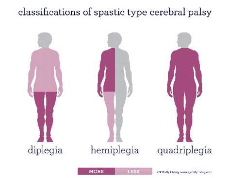 Spastic Cerebral Palsy | Cerebral Palsy Research Network