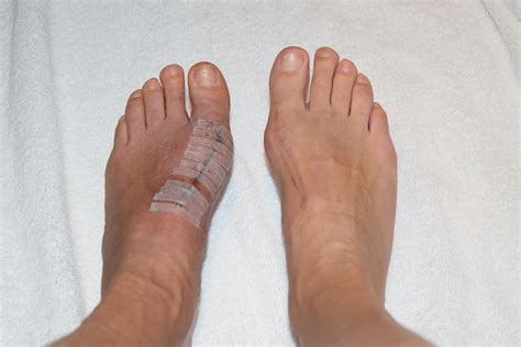 Update & Possible Right Foot Bunion Coming Back? – Lapidus Bunion ...