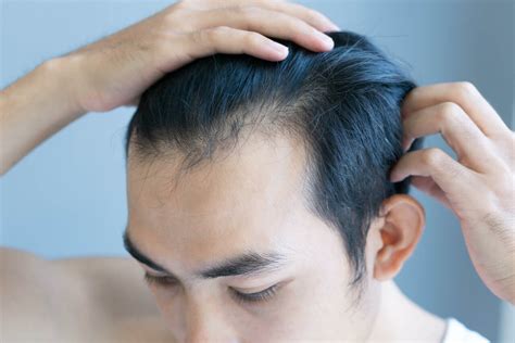 Should I be worried about my receding hairline? - myhair