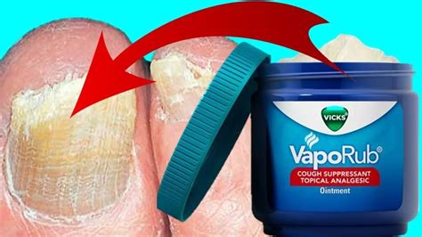 How To Use Vicks To Treat & Cure Toenail Fungus – FAST EASY REMEDY ...