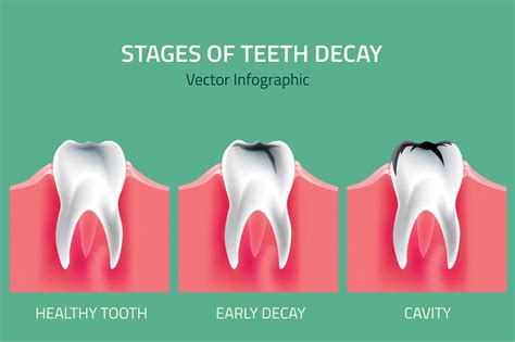 Stages of Teeth Decay | Healthcare Illustrations ~ Creative Market