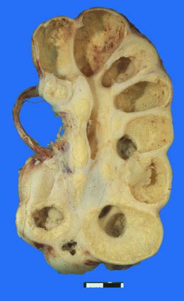 Pyonephrosis - Museum of Pathology