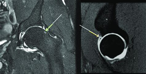 Hip Labrum Mri Anatomy