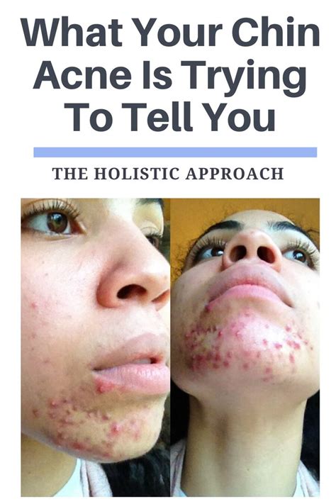 What Your Chin Acne Is Trying To Tell You | Chin acne, How to get rid ...