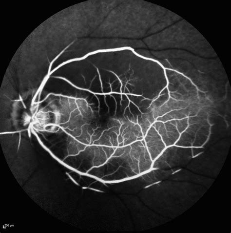 Central Retinal Artery Occlusion with Cilioretinal Sparing - Fundus ...