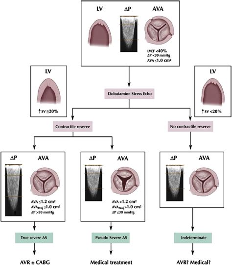 Severe Aortic Stenosis Echo