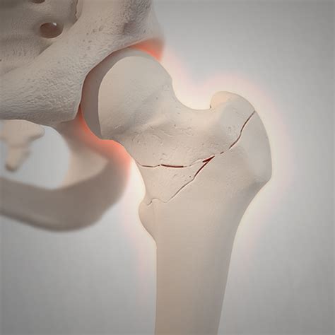 Bone Fracture Types and Symptoms | Globus Medical