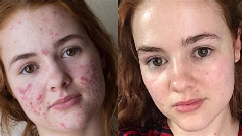 This Woman's Accutane Transformation Photos Went Viral — Before and ...