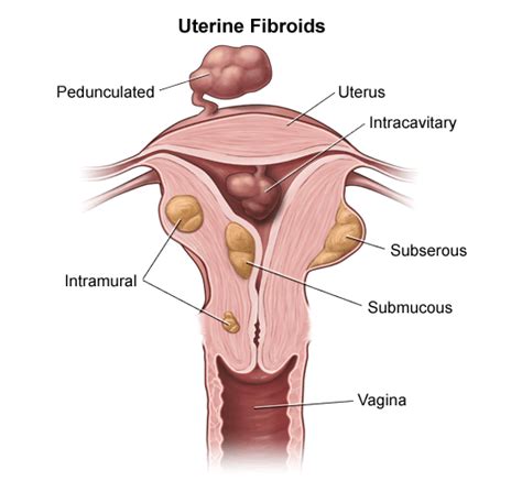 Uterine Leiomyosarcoma (ULMS) | Leiomyosarcoma Research & Support ...