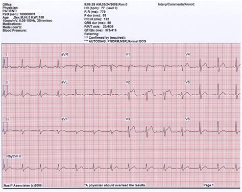 Normal Ecg Tracing