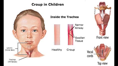 Home Remedies for Croup in Children - YouTube