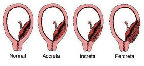 Placenta Accreta - What is, Symptoms, Risk Factors, Diagnosis