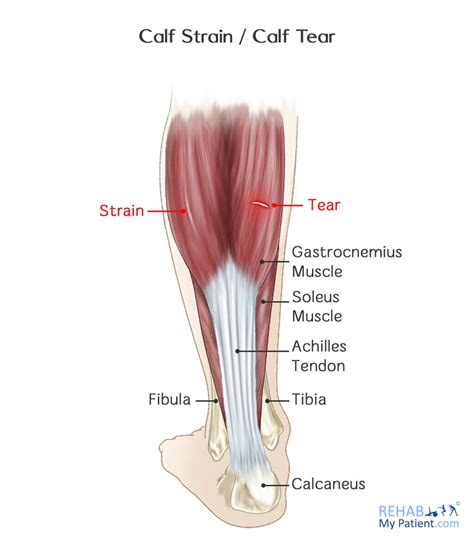 Calf Strain / Calf Tear | Rehab My Patient