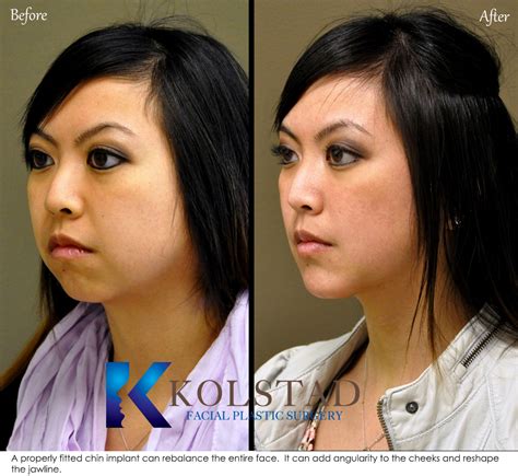 Chin Augmentation Before & After Gallery | Dr. Kolstad - San Diego ...