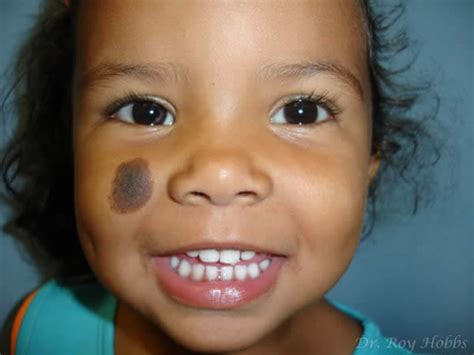 The Myths And Superstitions About Birthmarks - Procaffenation