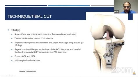 Unicondylar Knee Replacement — OrthopaedicPrinciples.com