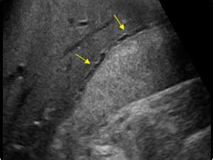 Abdomen and retroperitoneum | 1.2 Gallbladder and bile ducts : Case 1.2 ...