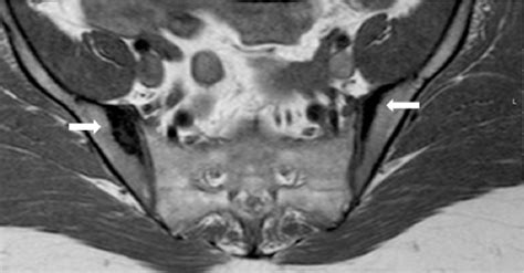 Sacroiliitis – Findings on Conventional Radiography, CT and MRI studies ...