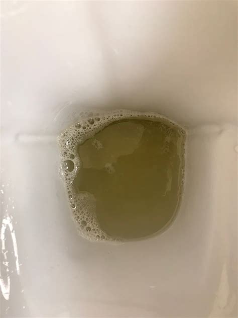 UKidney - Foam in urine but no protein found.