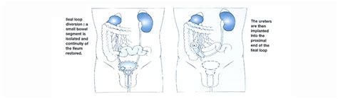 Urostomy