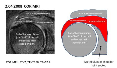 Full Thickness Supraspinatus Tear Mri