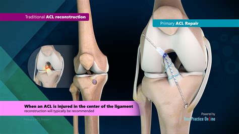 Primary ACL Repair Video | Medical Video Library