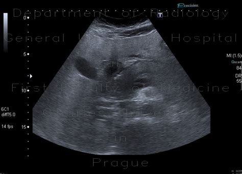 Radiology case: Acute pancreatitis on ultrasound