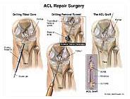 ACL Repair Surgery Medical Illustration Medivisuals