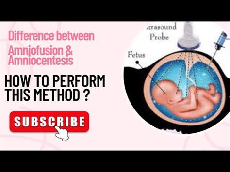 Difference between amnioinfusion & aminocentesis.How to perform this ...