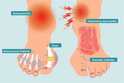 How Arthritis Strikes Your Feet, and 11 Ways to Heal Your Arthritis ...