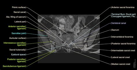 Sacral Vertebrae Diagram