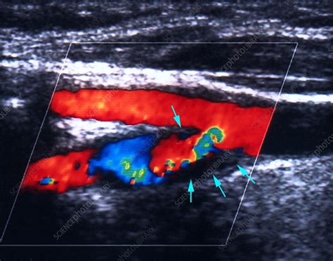 Atheroma plaque, doppler ultrasound - Stock Image - M175/0374 - Science ...