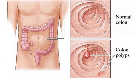 Tubular adenoma of colon, causes, diagnosis & treatment