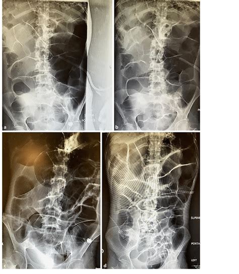 a-d Chronic intestinal pseudo-obstruction. There is dilatation of the ...