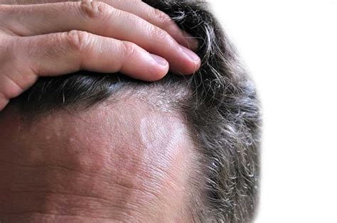 12 Dandruff Causes—and How to Stop the Itch - University Health News