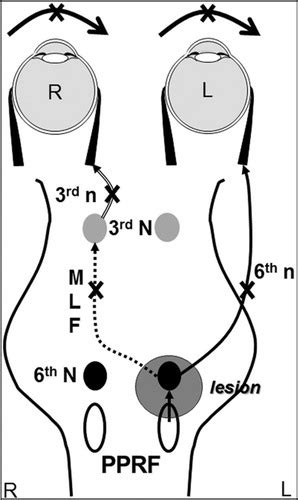 Conjugate Vertical Gaze